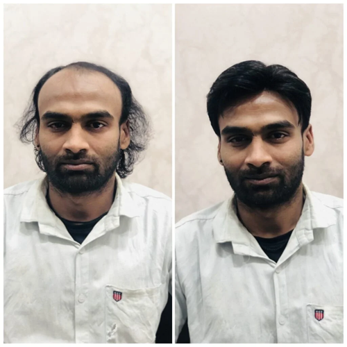 Before After Hair Transformation